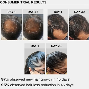 Bare Anatomy Advanced Hair Growth Serum | 3% Redensyl + 4% Anagain + 3% Baicapil + 1% Capilia Longa | 214% Hair Growth in 10 Days, 89% Hair Loss Reduction